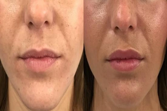 of our patients 0 smile line fillers, removing nasolabial fold wrinkles, smile lines filler, price, nasolabial fold