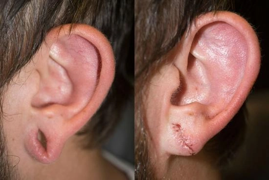 of our patients 1 Earring hole repair, repair, prices, Turkey, ear hole repair, earlobe closing
