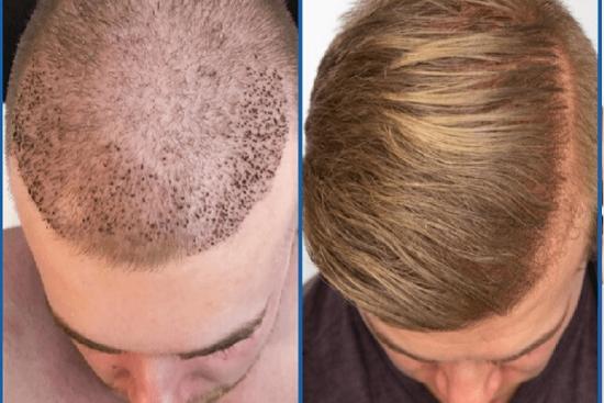 Hair transplant cost in Turkey, Prices & Clinics