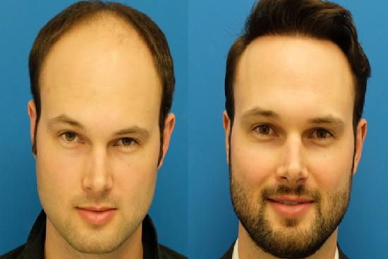  Photos: Before / After 0 in Turkey hair transplant cost per graft,transplant, cost,per,fue hair transplant cost,fue,hair grafting cost,average cost of hair restoration,Average,restoration,non surgical,grafts,grafting,fue,fut