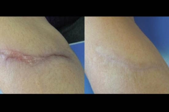 наших пациентов 3 Удаление рубцов и шрамов, Стамбул, Турция, цена