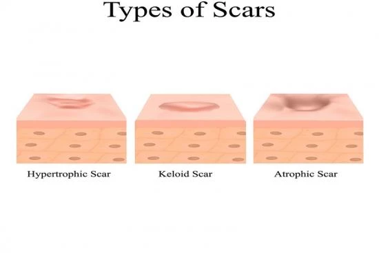 What are the types of scars? 2024