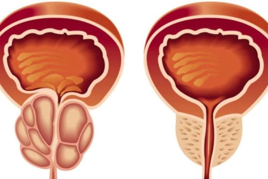 نتائج علاج تضخم البروستاتا