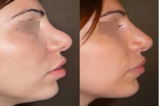 Photos Avant / Après 3 rhinoplastie, Istanbul, meilleures cliniques, prix, clinique, Turquie