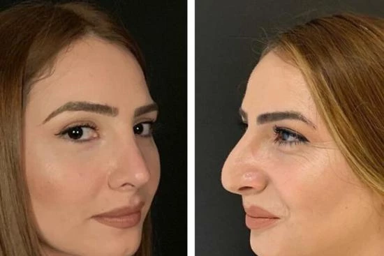 Types of the nose job surgery