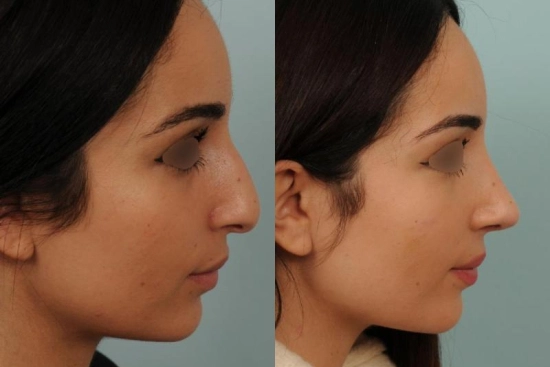 Nose job surgery in Turkey