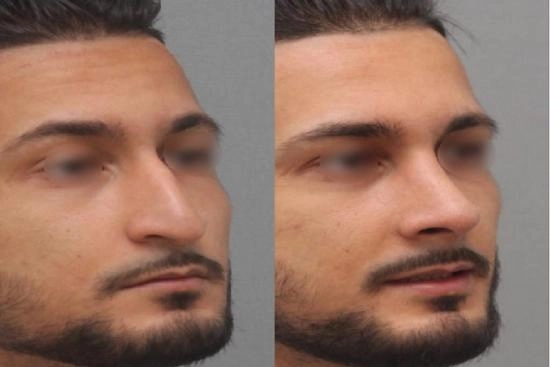 Photos Avant / Après 4 rhinoplastie, Istanbul, meilleures cliniques, prix, clinique, Turquie
