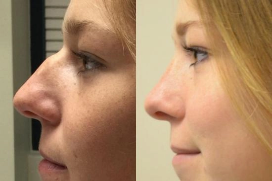 Photos Avant / Après 1 rhinoplastie, Istanbul, meilleures cliniques, prix, clinique, Turquie