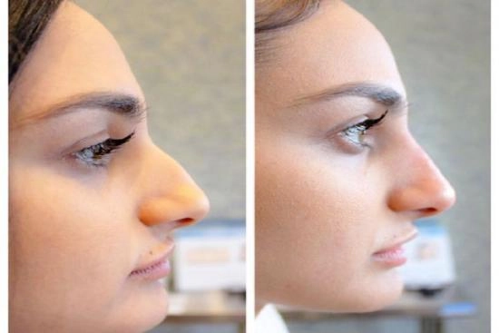 Photos Avant / Après 2 rhinoplastie, Istanbul, meilleures cliniques, prix, clinique, Turquie