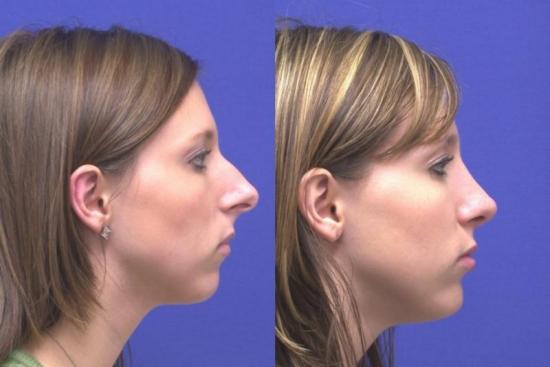  Photos: Before / After 0 in Turkey best, rhinoplasty, surgeon, nose Job, nose reshaping, clinic, price, turkey