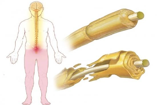 Síntomas de la esclerosis múltiple 2025