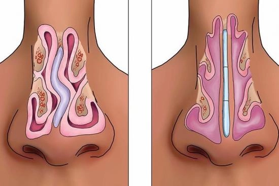 انحراف الحاجز الأنفي: الأسباب والأعراض 2024
