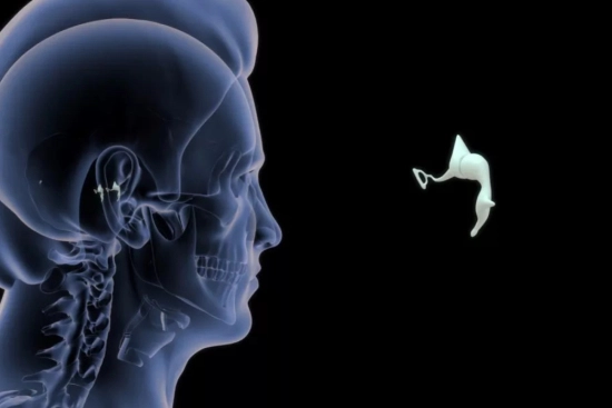 Diagnosis prior to stapedectomy 2025