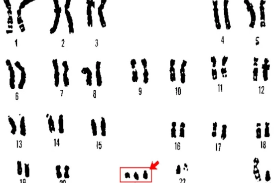 Down syndrome symptoms