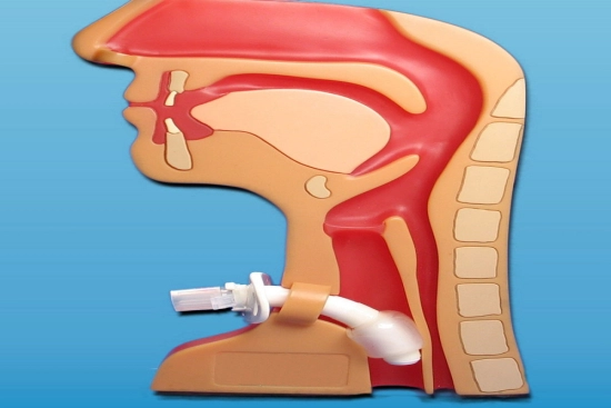 tracheostomy in Turkey