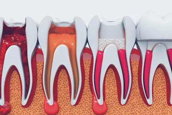 Traitement de canal dentaire 