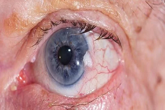 Eye cancer treatment Turkey 