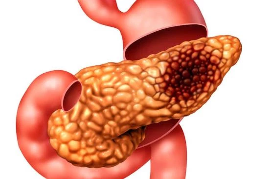 Pancreatic cancer treatment in Turkey