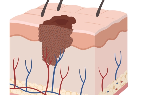 Skin cancer: What is it? 2026