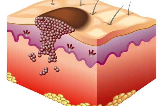 جراحة إزالة سرطان الجلد 2025