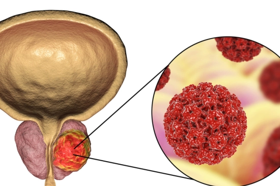 Cáncer de próstata: opciones de tratamiento en Turquía 2025