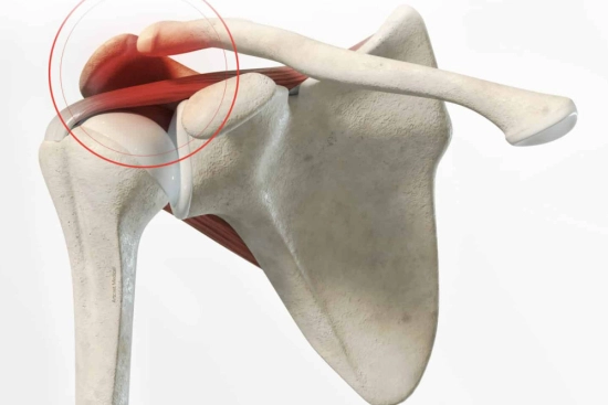 Causes of subacromial impingement of the shoulder 2024