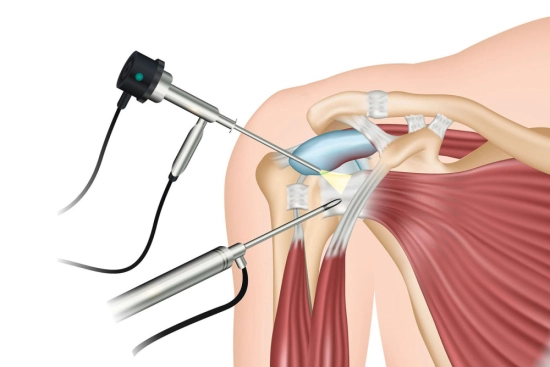 acromioplastie en Turquie