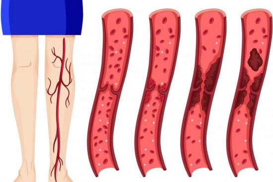 Arteriopathy obliterans treatment Turkey 