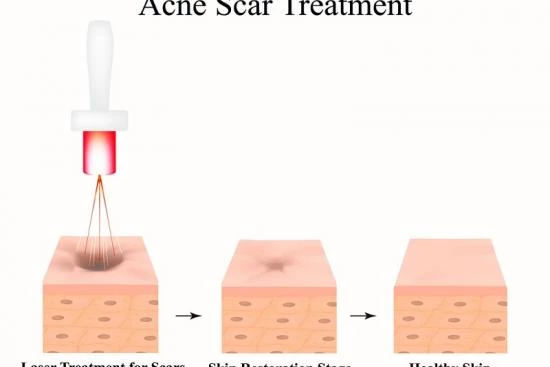 Traitement de l’acné au laser 