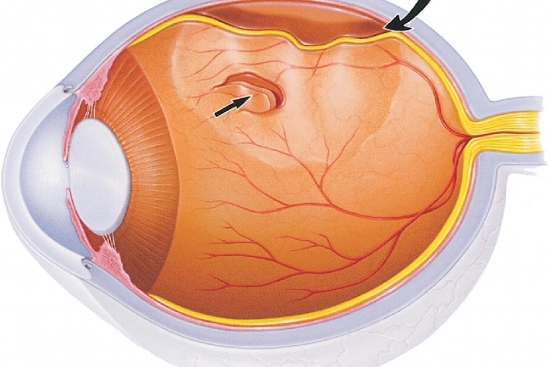 Décollement de la rétine