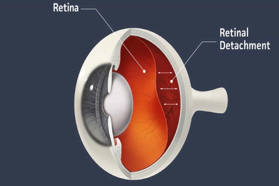 Retinal detachment