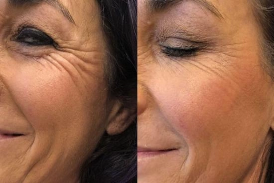 of our patients 2 Wrinkle filling, treatment, Turkey, aging process