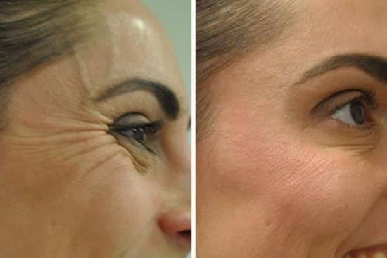 of our patients 3 Wrinkle filling, treatment, Turkey, aging process