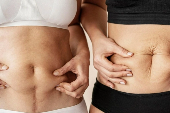 Traitement du diastasis abdominal en Turquie