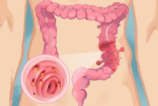 Treatment options for colonic diverticulosis in Turkey 2026