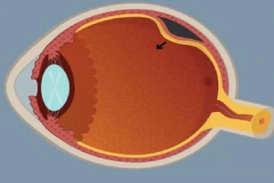 Retinal Detachment Treatment in Turkey 2024