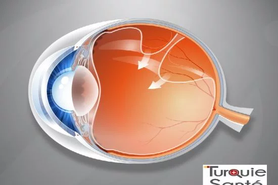 Лечение отслоения сетчатки глаза Турция 