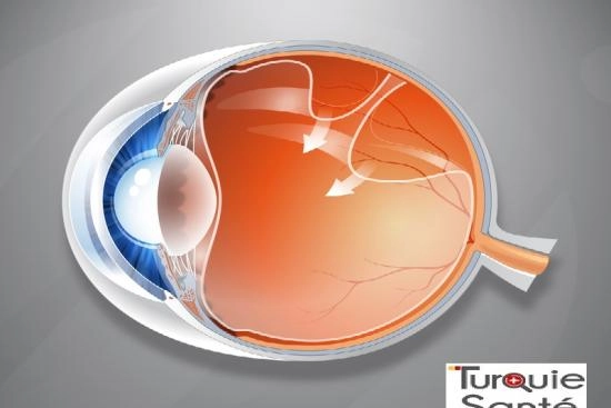 cirugía del desprendimiento de retina en Turquía