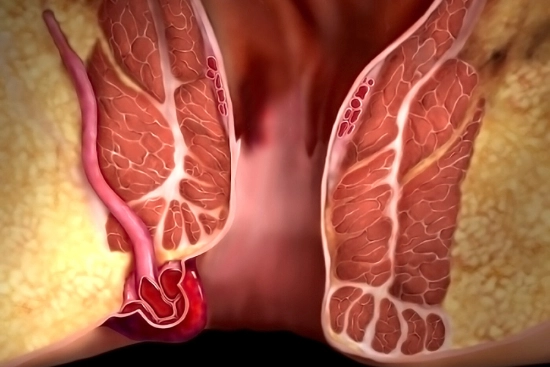 Lateral internal sphincterotomy (SLI) in Turkey 2026 Lateral internal sphincterotomy (SLI) in Turkey 2026