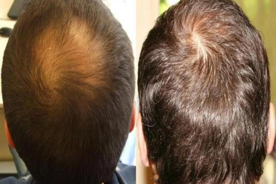 لمرضانا 0 التكلفة، الثعلبة الأندروجينية، تساقط الشعر الهرموني