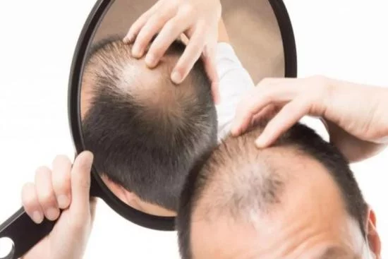 Traitement de la perte de cheveux hormonale 