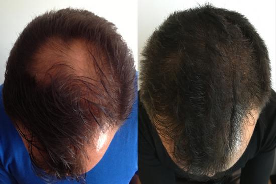 Prix du traitement de la perte hormonale des cheveux en Turquie