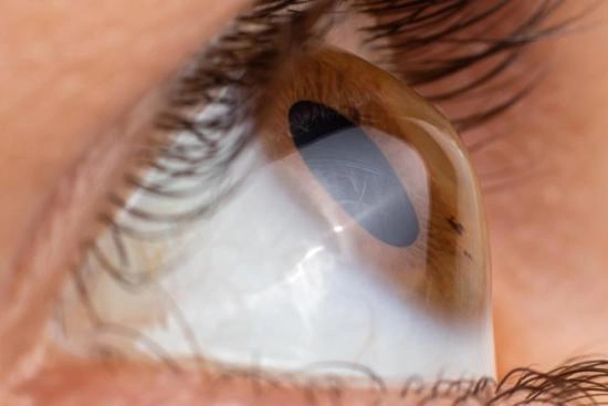 Keratoconus treatment in Turkey