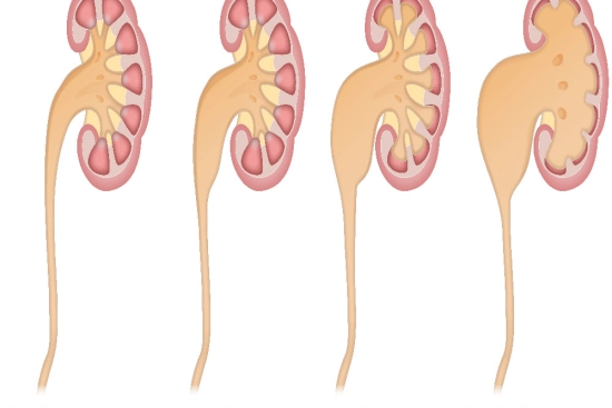 Diagnosis of hydronephrosis 2025