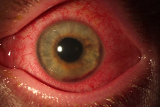 Как проводится диагностика увеита в Турции? 2026