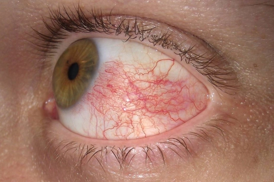 uveitis symptoms