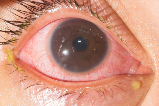 uveitis treatment