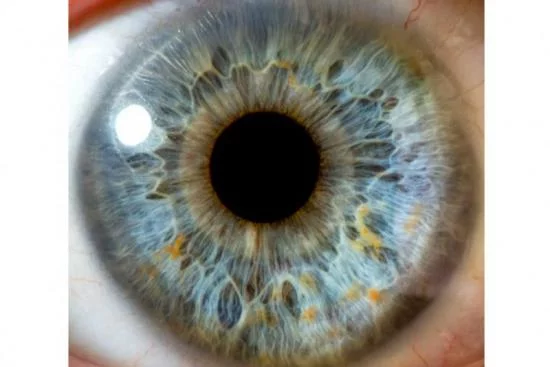 Лечение пигментного ретинита (абиотрофия сетчатки глаза) Турция 