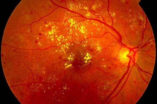 Лечение диабетической ретинопатии (ДР) Турция 