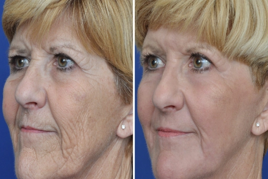 Wrinkle filling: Treatment options in Turkey 2025